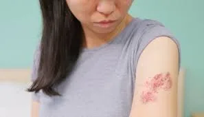 Which Natural Treatments Ensure Relief from Shingles?